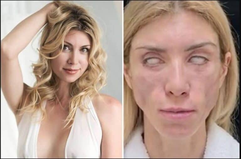 عملية تجميل تدمر وجه ملكة جمال بشكل غير متوقع watanserb.com