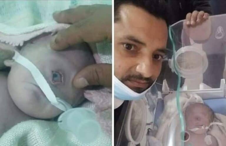 ولادة طفل يمني بعين واحدة.. وهذا ما حدث بعد 7 ساعات فقط! (شاهد) watanserb.com