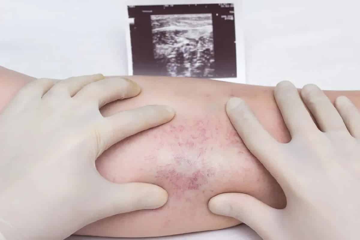 -إذا كانت الجلطة حميدة في البداية، يمكن أن تصبح قاتلة في مراحل متقدمة