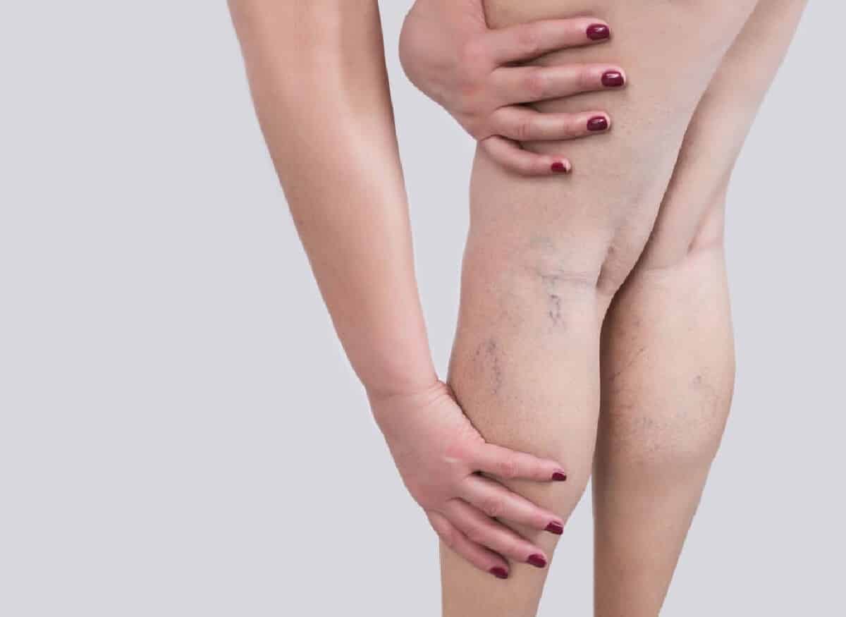 الجلطة في الأساس جلطة دموية، يحدث تكوينها في وعاء دموي أو في الوريد أو في الشريان.