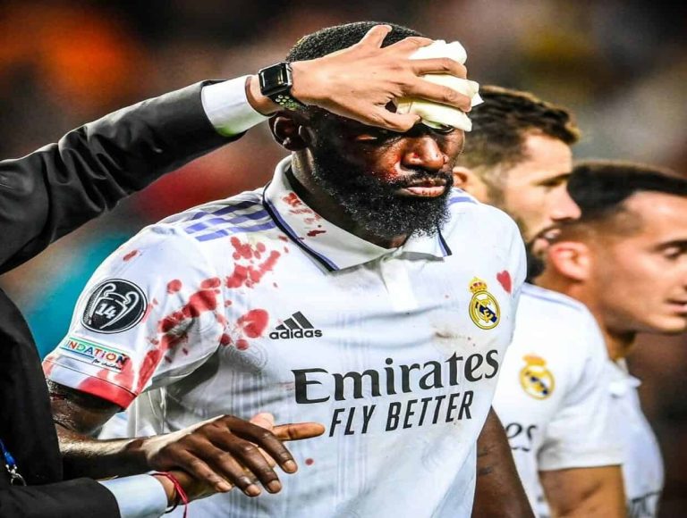 إصابة روديجر المروعة بعد إنقاذه ريال مدريد في الثواني الأخيرة (فيديو) إصابة روديجر أمام شاختار في دوري الأبطال watanserb.com
