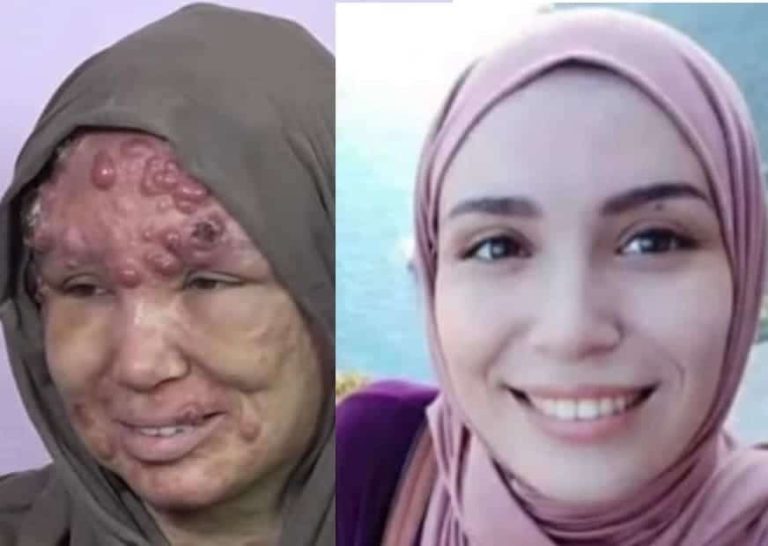إيمان بوخالفة.. شابة جزائرية تثير تعاطف الآلاف بسبب ما حدث لوجهها! watanserb.com