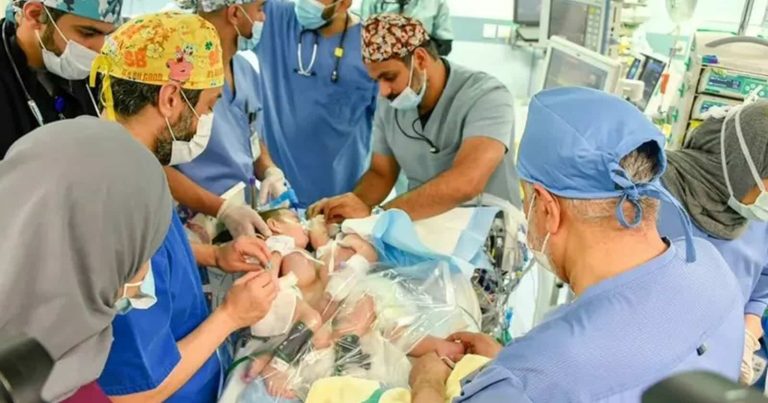 مؤثر.. رد فعل والد التوأم السيامي العراقي بعد نجاح عملية الفصل (فيديو) التوأم السيامي العراقي watanserb.com