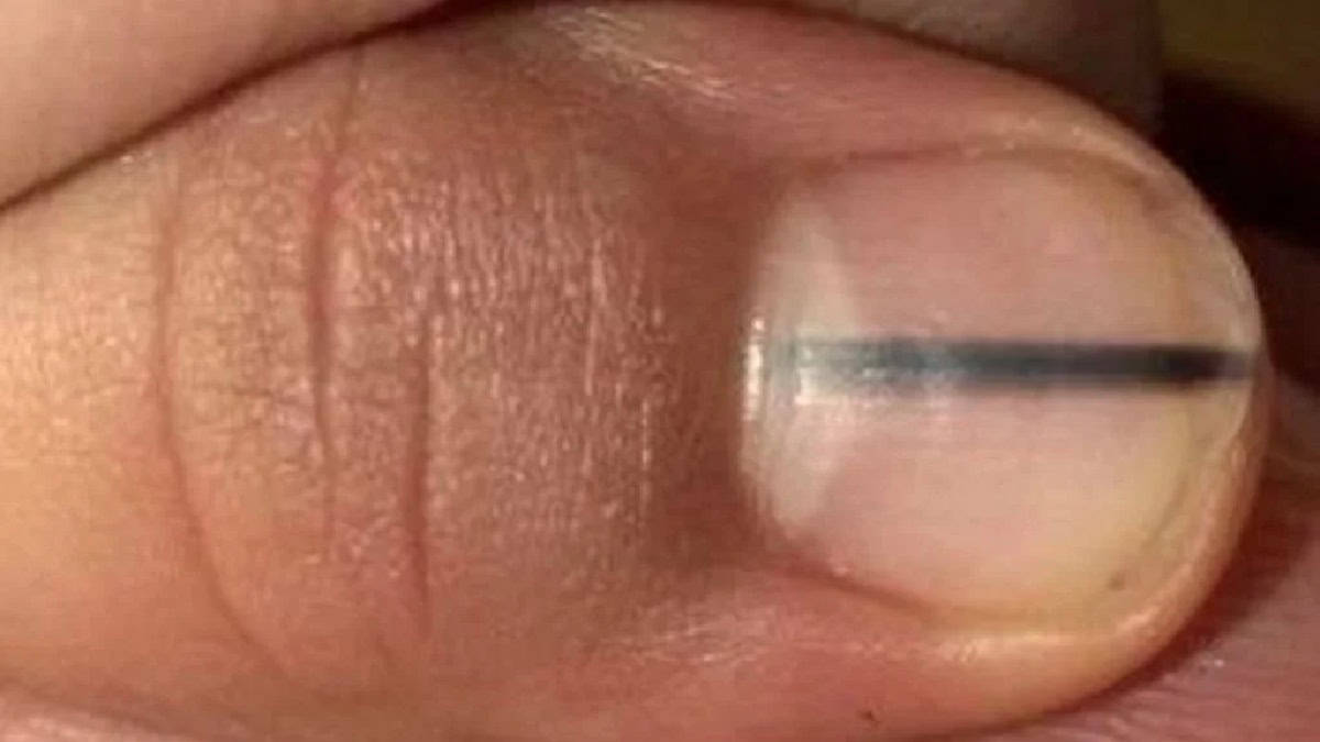 الورم الميلانيني تحت الأظافر؛ هو نوع نادر من السرطان