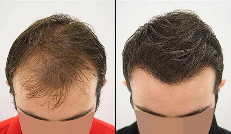 زرع الشعر مع التزلج على الجليد.. استراتيجية تركية لرفع الإيرادات زراعة الشعر