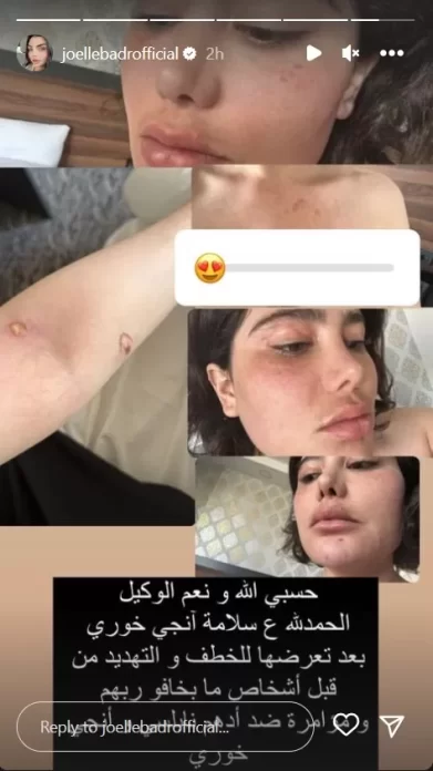 آثار اعتداء على جسد إنجي خوري 