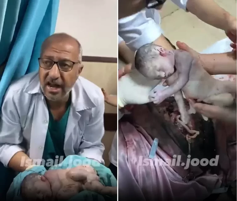 اخراج جنين من بطن والدته الشهيدة