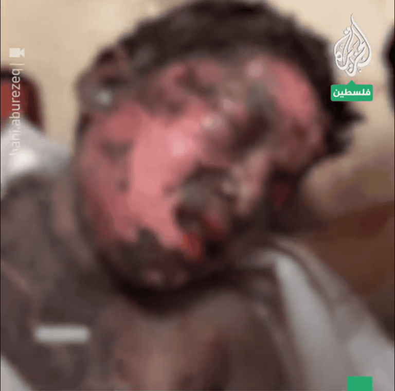طفل فلسطيني شوهت الحروق جسمه