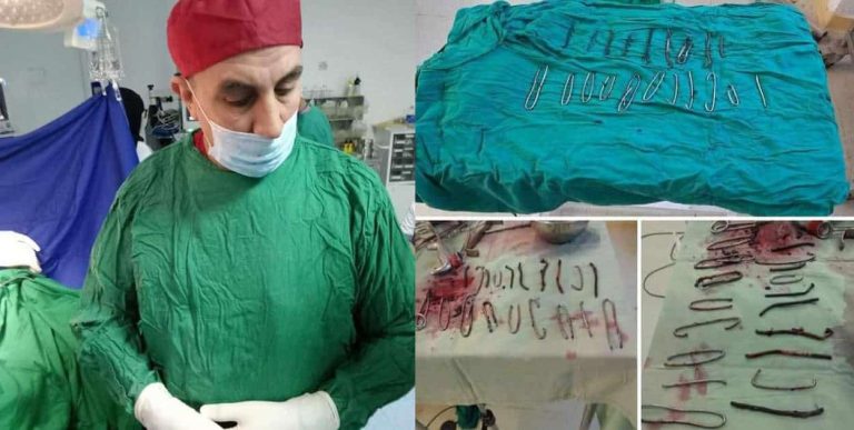 نجح أطباء في الجزائر باستخراج 20 مسماراً ومجموعة من الأسلاك المعدنية من بطن مواطن مريض