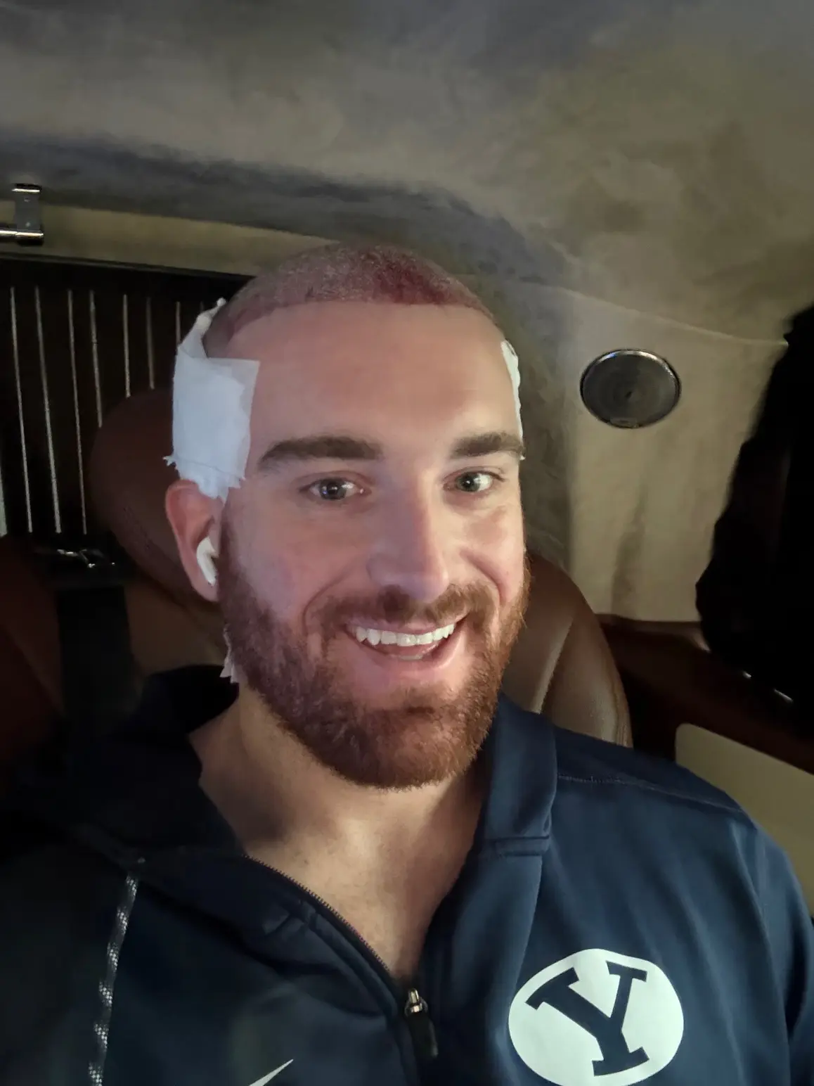 انتشرت صور عملية زراعة الشعر التي أجراها كينيون في تركيا بشكل كبير على وسائل التواصل الاجتماعي.