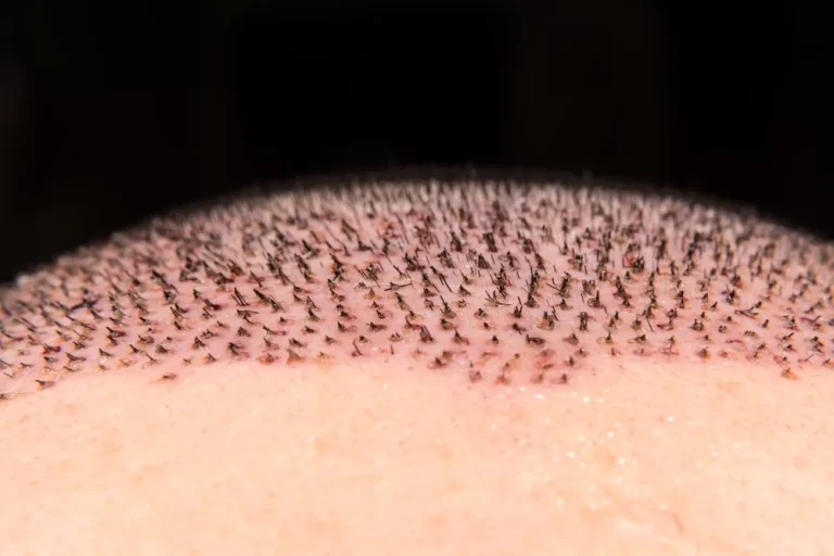 زراعة الشعر بتقنيات حديثة